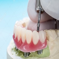 възстановяване след поставяне на зъбни импланти - 96414 комбинации