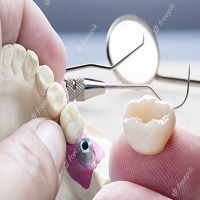 възстановяване след поставяне на зъбни импланти - 19010 награди