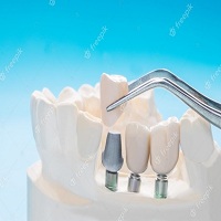 възстановяване след поставяне на зъбни импланти - 98720 снимки