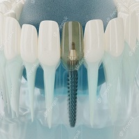 възстановяване след поставяне на зъбни импланти - 49635 варианти