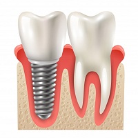 възстановяване след поставяне на зъбни импланти - 49271 клиенти