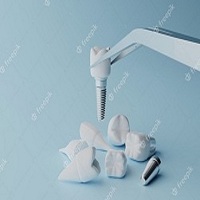 възстановяване след поставяне на зъбни импланти - 60480 предложения