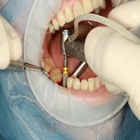 възстановяване след поставяне на зъбни импланти - 88943 промоции