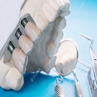 възстановяване след поставяне на зъбни импланти - 81775 клиенти
