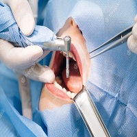 възстановяване след поставяне на зъбни импланти - 12591 награди