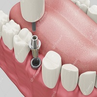 зъбни импланти - 71436 новини