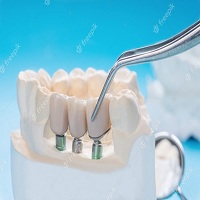 зъбни импланти - 84346 промоции