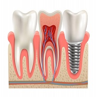 зъбни импланти - 33736 вида