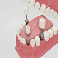 зъбни импланти - 65551 цени