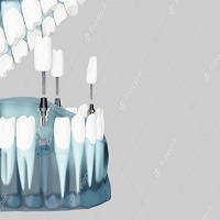 зъбни импланти - 77567 възможности