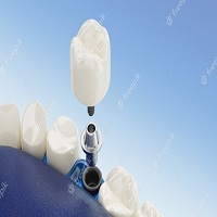 зъбни импланти - 11097 награди