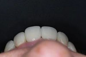 бондинг на зъби - 73383 типа | Supreme Dental бондинг на зъби - 62509 типа